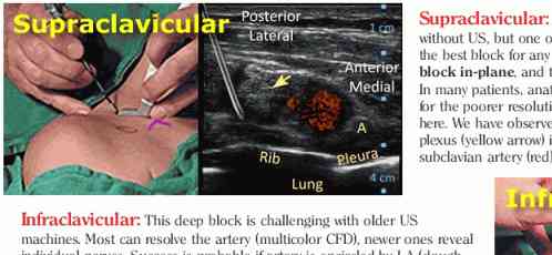 Supraclavicular block Detail